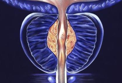 PSMA-PET-CT可顯著提升前列腺癌早期轉(zhuǎn)移診斷的準(zhǔn)確率