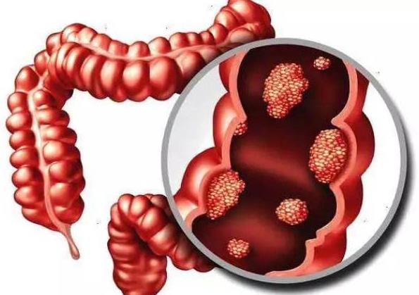 日本順天堂教授談：糞便移植治療潰瘍性結(jié)腸炎的研究結(jié)果